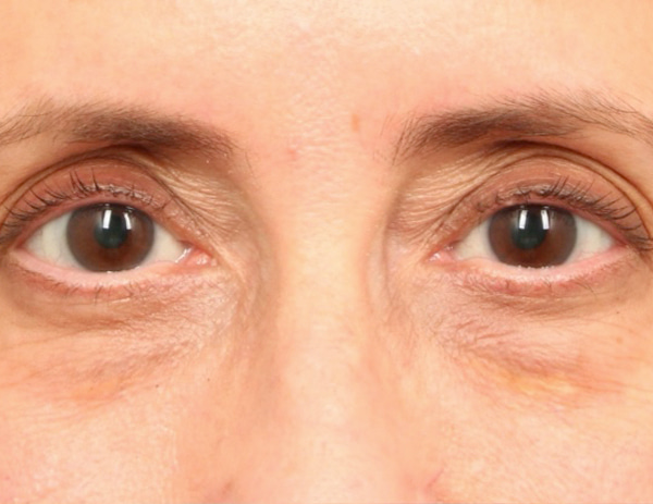 Lower Blepharoplasty Before & After Image
