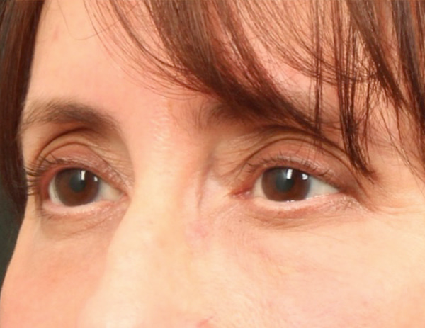 Lower Blepharoplasty Before & After Image