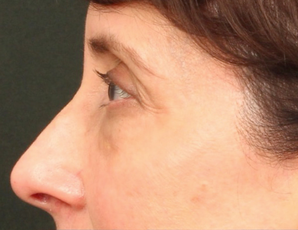 Lower Blepharoplasty Before & After Image
