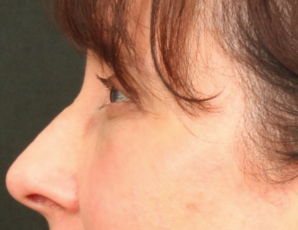 Lower Blepharoplasty Before & After Image