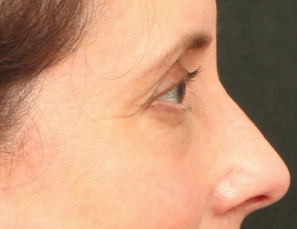 Lower Blepharoplasty Before & After Image