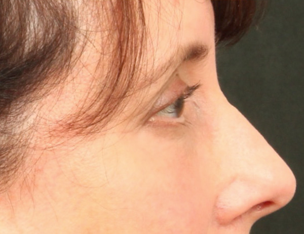 Lower Blepharoplasty Before & After Image