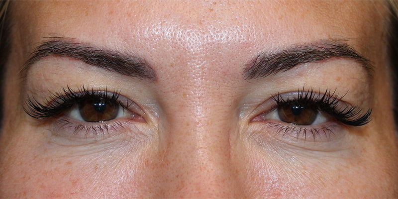 Upper Blepharoplasty Before & After Image