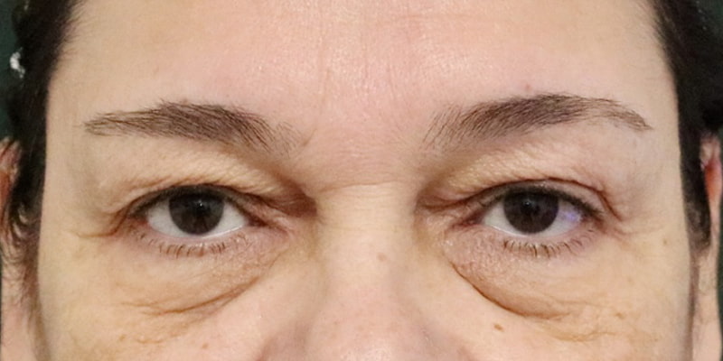 Upper Blepharoplasty Before & After Image