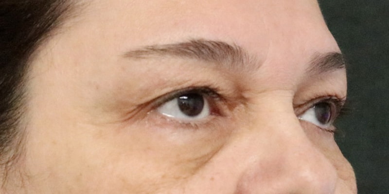 Upper Blepharoplasty Before & After Image