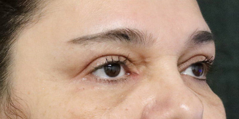 Upper Blepharoplasty Before & After Image