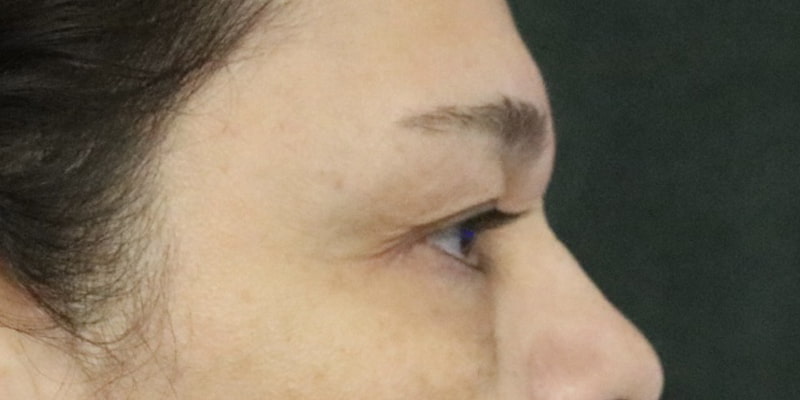 Upper Blepharoplasty Before & After Image