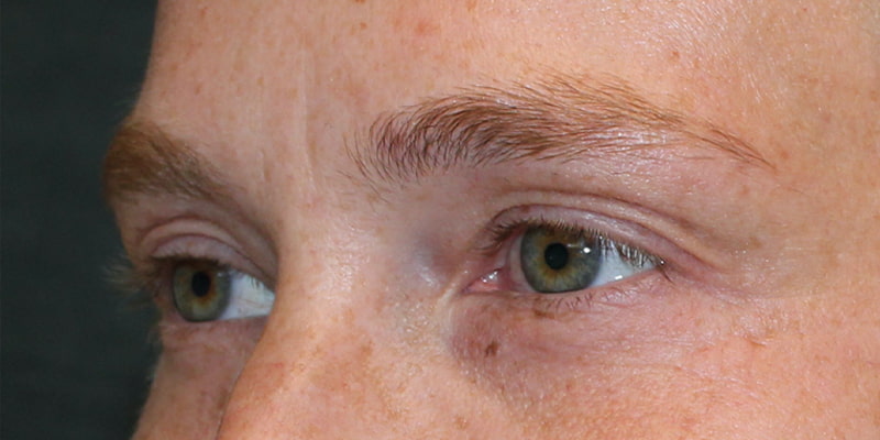 Upper Blepharoplasty Before & After Image