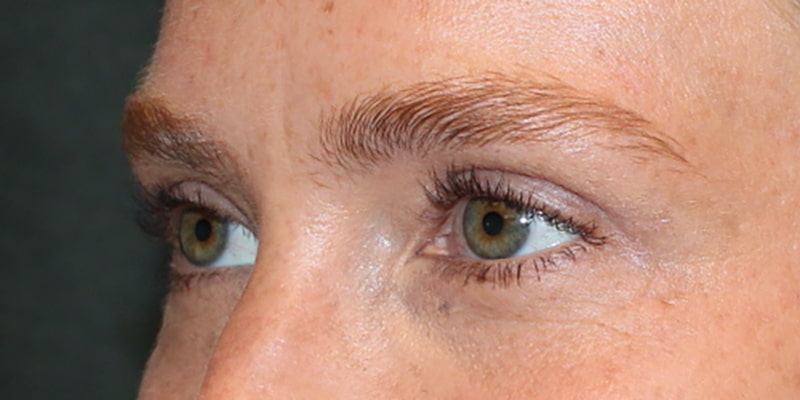 Upper Blepharoplasty Before & After Image