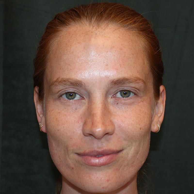 Upper Blepharoplasty Before & After Image