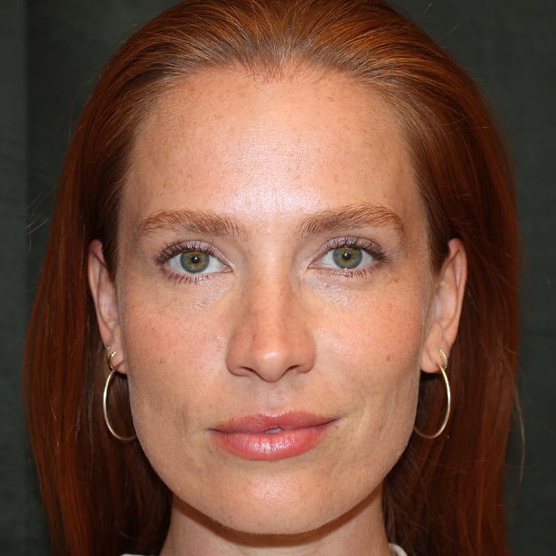 Upper Blepharoplasty Before & After Image