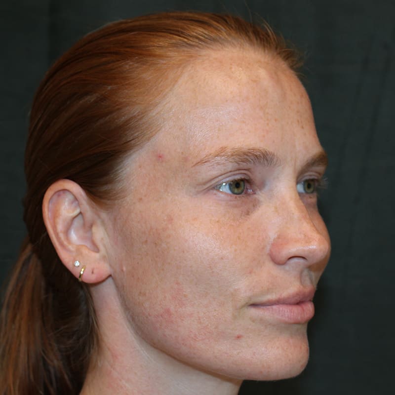 Upper Blepharoplasty Before & After Image