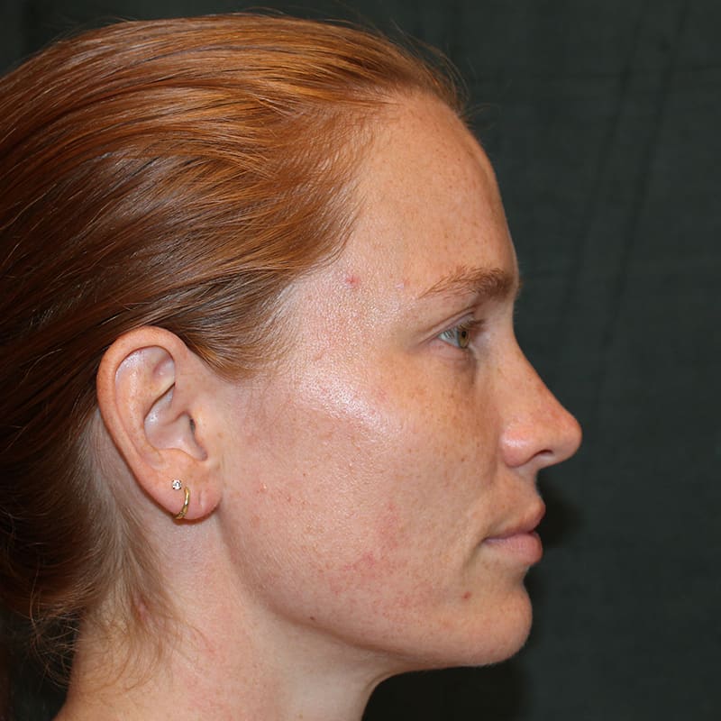 Upper Blepharoplasty Before & After Image