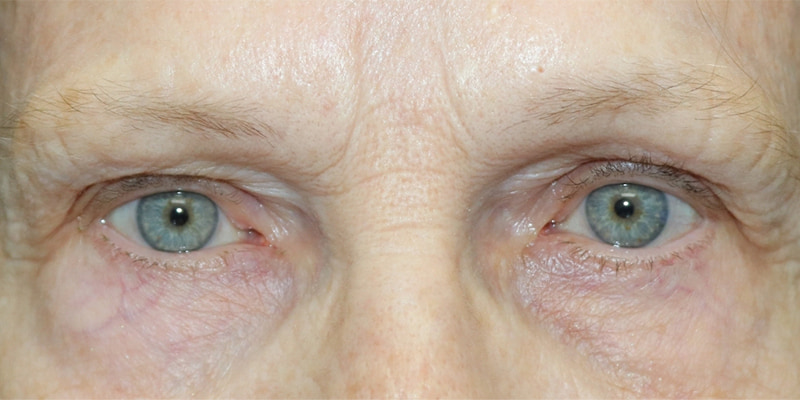 Upper Blepharoplasty Before & After Image