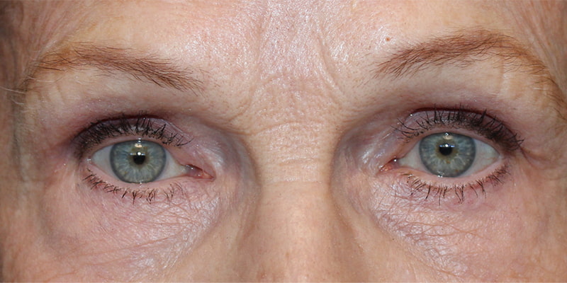 Upper Blepharoplasty Before & After Image