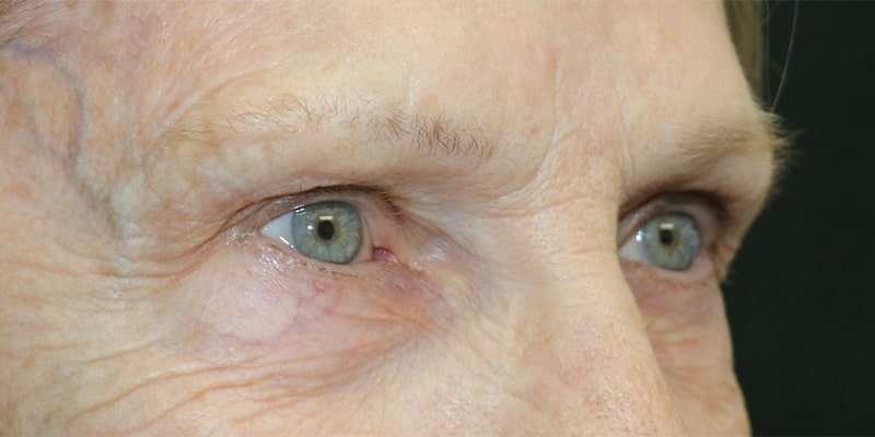 Upper Blepharoplasty Before & After Image