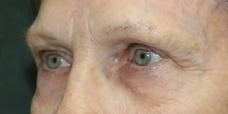 Upper Blepharoplasty Before & After Image