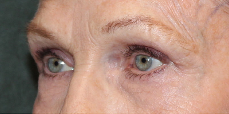 Upper Blepharoplasty Before & After Image