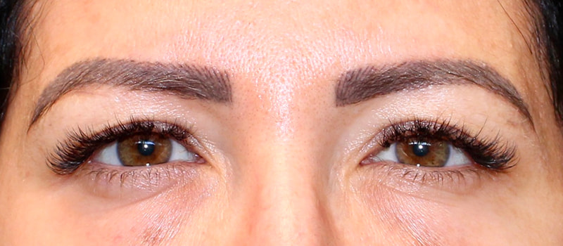 Upper Blepharoplasty Before & After Image