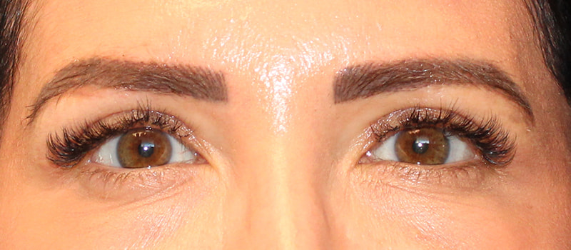 Upper Blepharoplasty Before & After Image