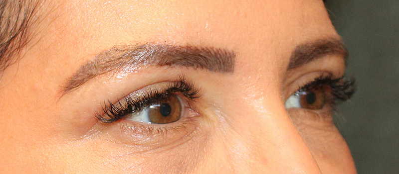 Upper Blepharoplasty Before & After Image