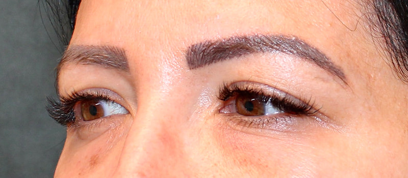 Upper Blepharoplasty Before & After Image