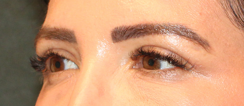 Upper Blepharoplasty Before & After Image