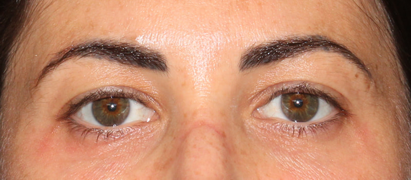 Upper Blepharoplasty Before & After Image