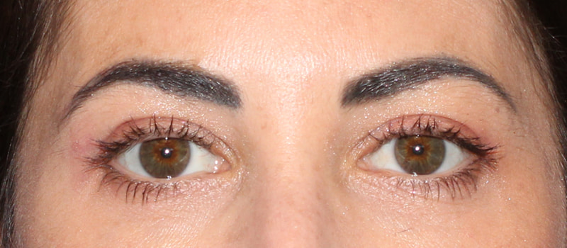 Upper Blepharoplasty Before & After Image