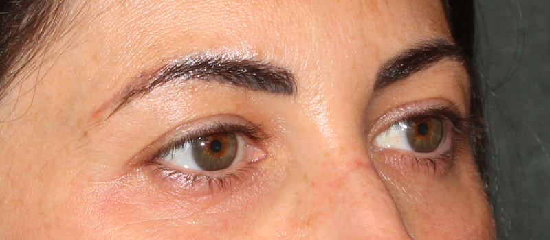 Upper Blepharoplasty Before & After Image