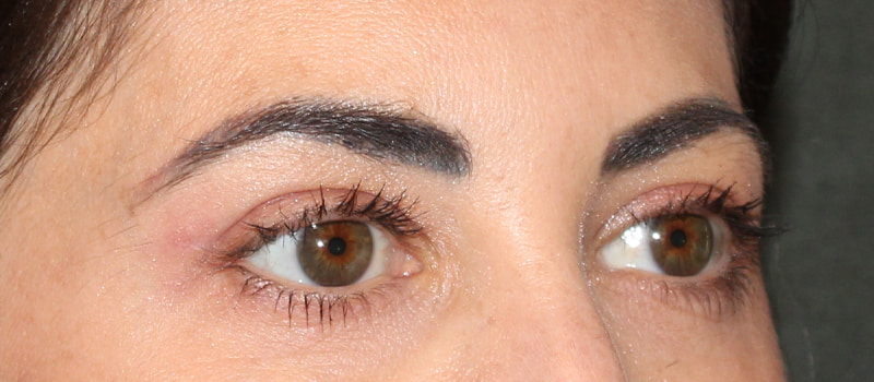 Upper Blepharoplasty Before & After Image