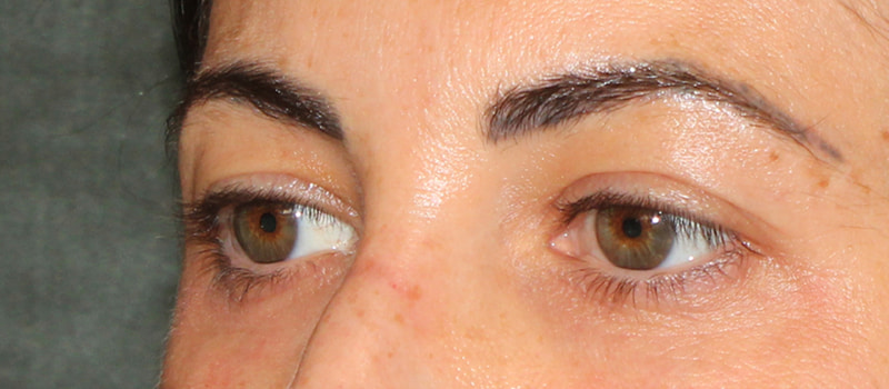 Upper Blepharoplasty Before & After Image