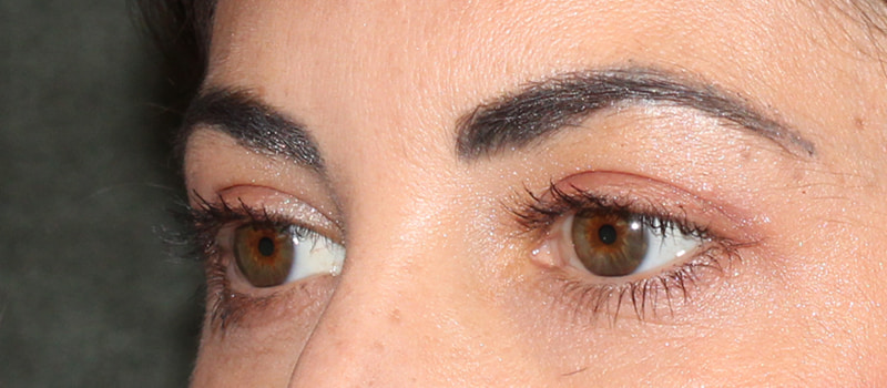 Upper Blepharoplasty Before & After Image