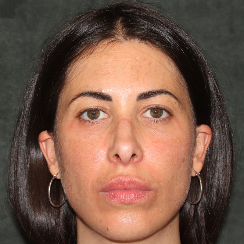 Upper Blepharoplasty Before & After Image