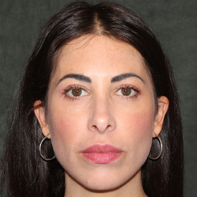 Upper Blepharoplasty Before & After Image