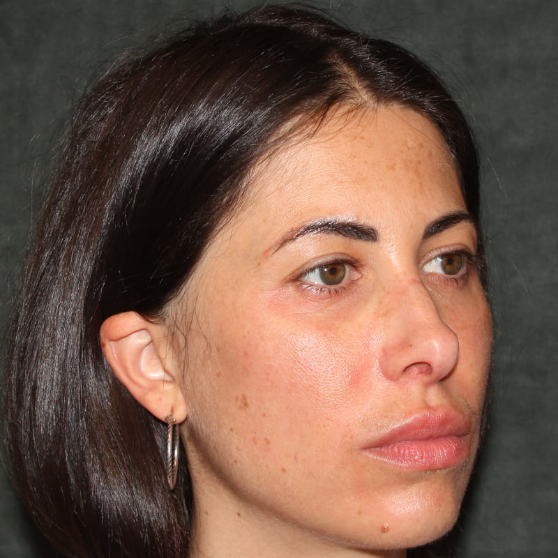 Upper Blepharoplasty Before & After Image