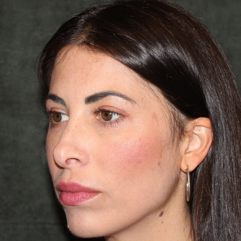 Upper Blepharoplasty Before & After Image