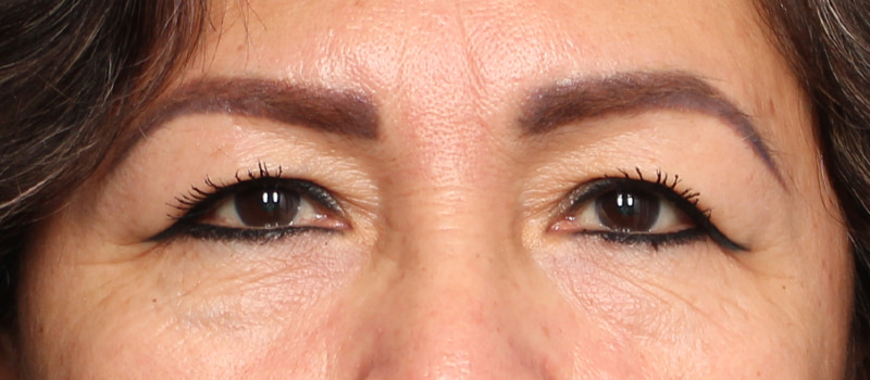 Upper Blepharoplasty Before & After Image