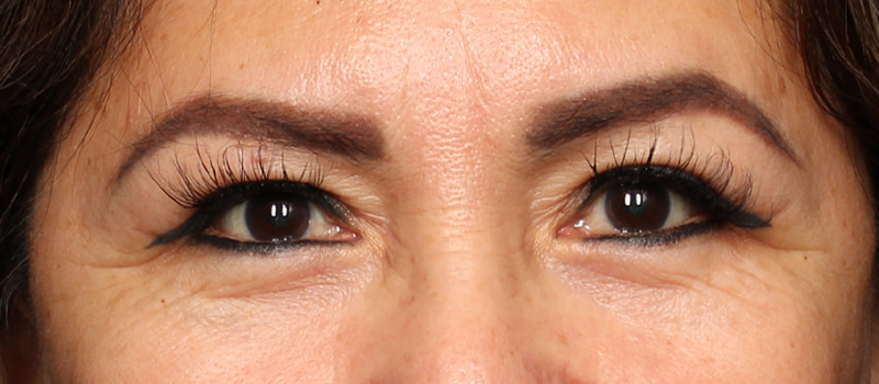 Upper Blepharoplasty Before & After Image