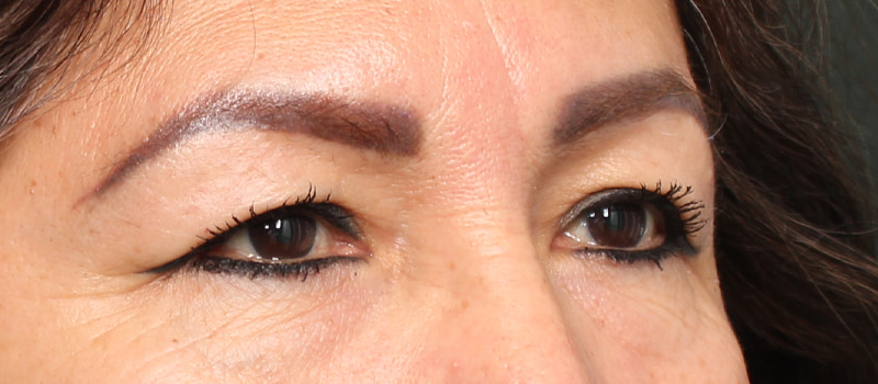 Upper Blepharoplasty Before & After Image