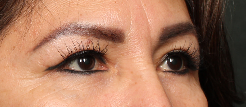 Upper Blepharoplasty Before & After Image