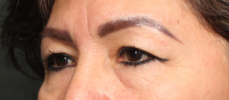 Upper Blepharoplasty Before & After Image