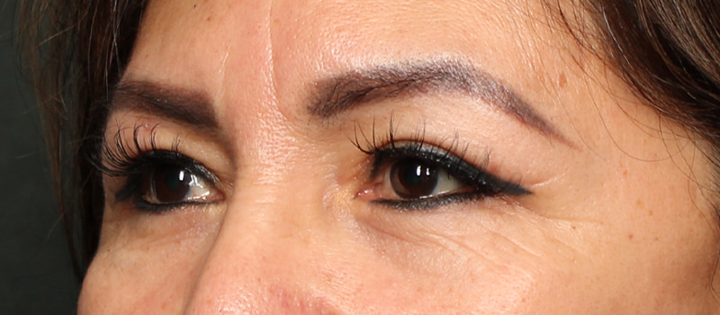 Upper Blepharoplasty Before & After Image