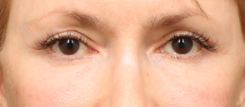 Upper Blepharoplasty Before & After Image