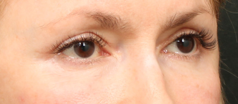 Upper Blepharoplasty Before & After Image