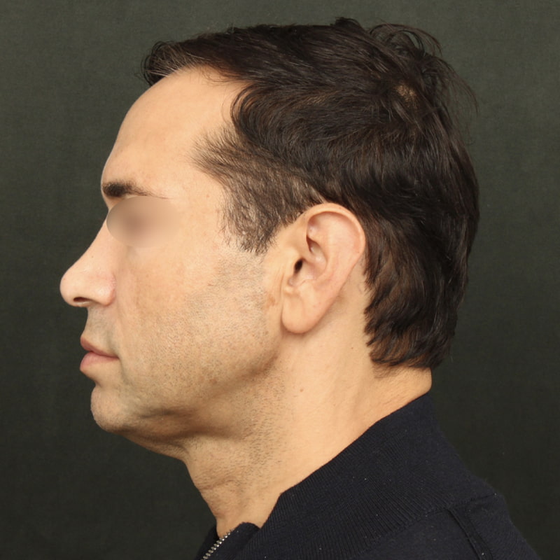 Deep Plane Facelift Before & After Image