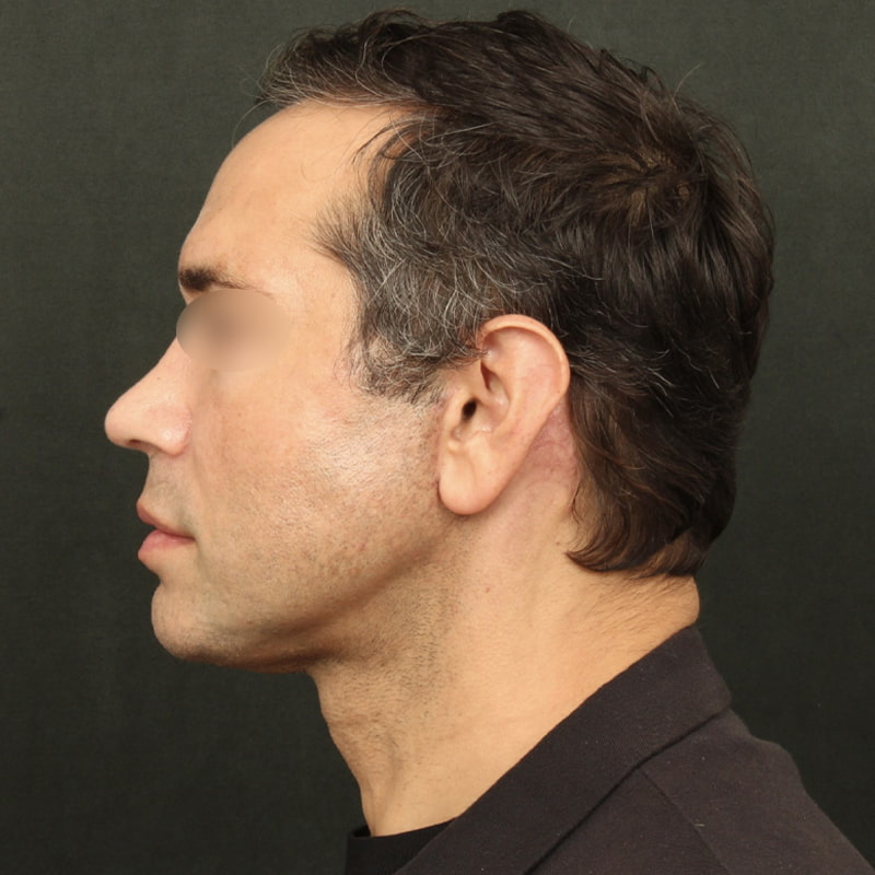 Deep Plane Facelift Before & After Image