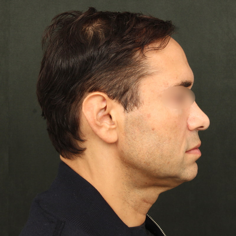 Deep Plane Facelift Before & After Image