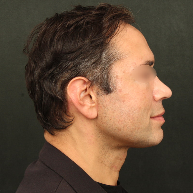 Deep Plane Facelift Before & After Image