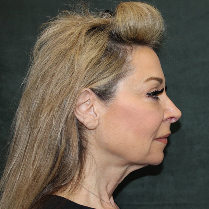 Deep Plane Facelift Before & After Image